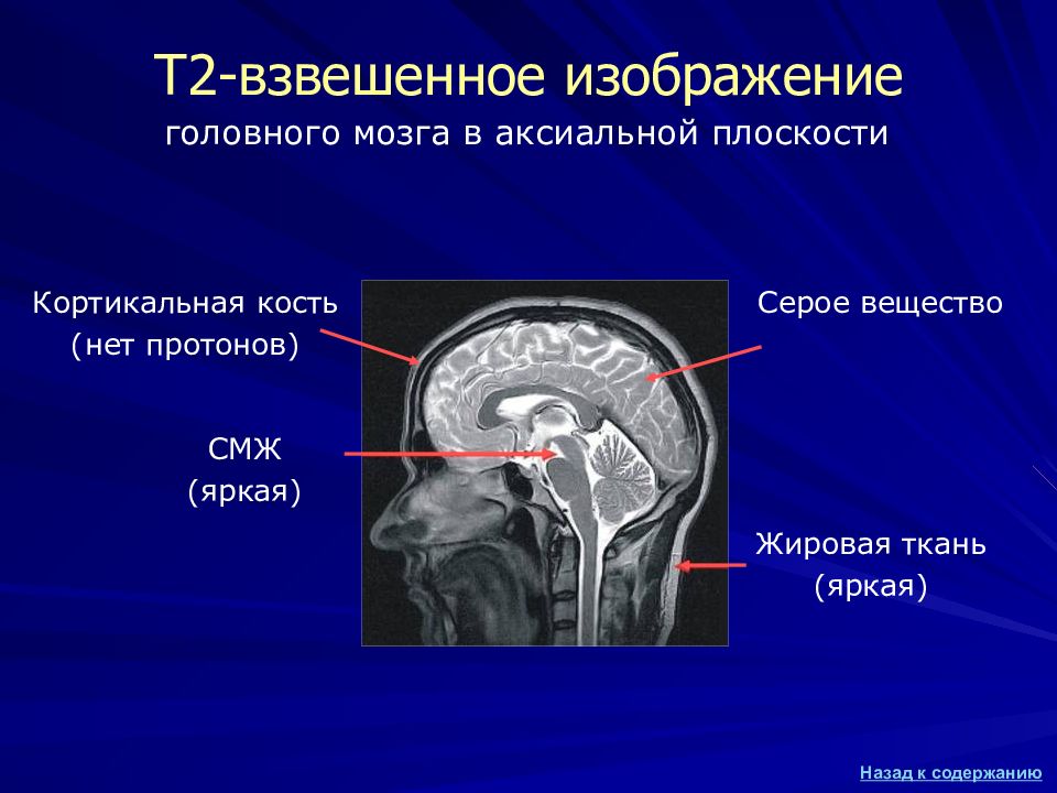 Т2 изображение в мрт