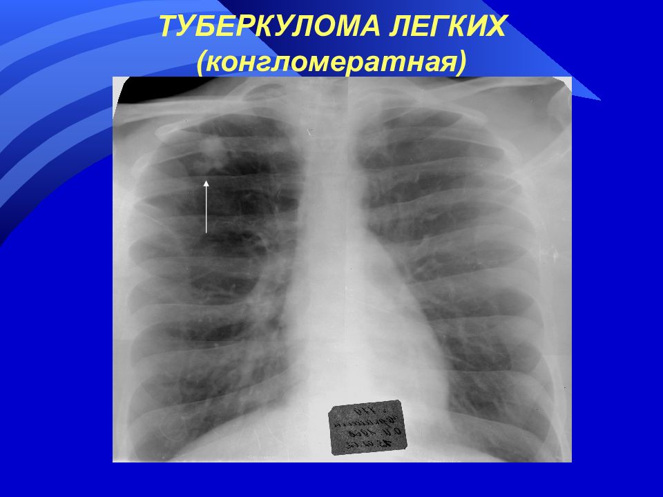 Легких форум. Туберкулома и кавернозный туберкулез. Рентген туберкулез туберкулема. Туберкулема на рентгенограмме. Туберкулема легких рентген.