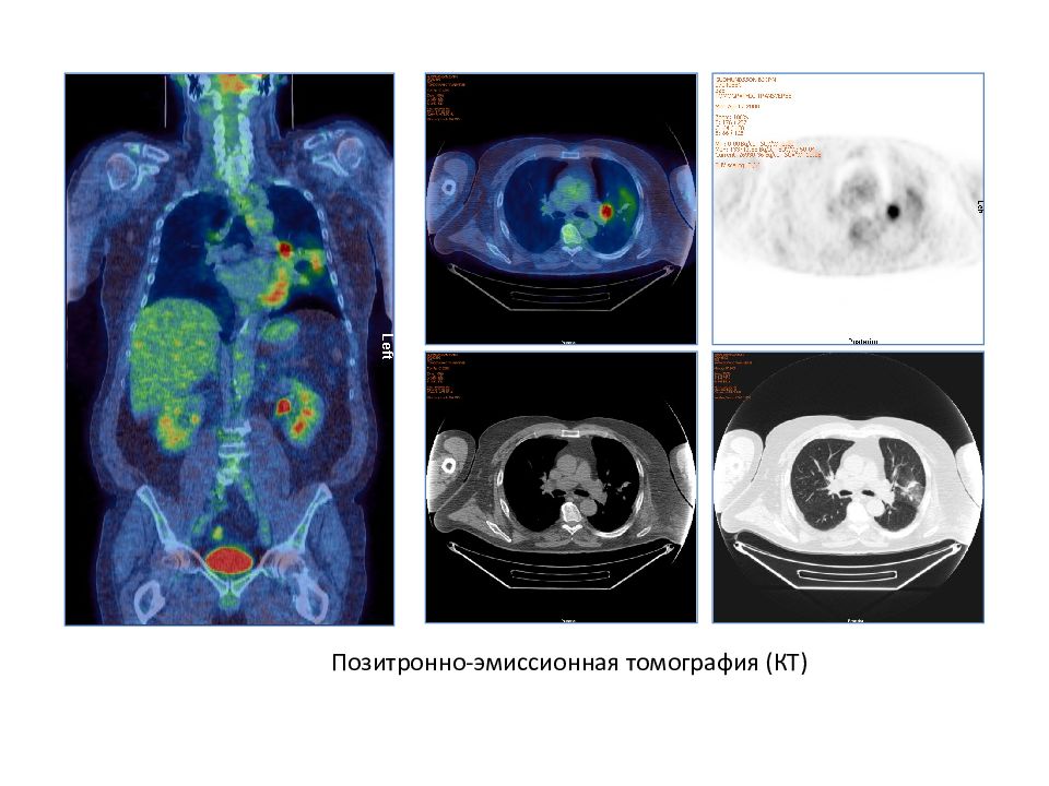 Пэт кт что это за исследование. Позитронно эмиссионная томография онкология. Позитронно эмиссионная томография почек. Позитронно-эмиссионная томография глаз. Позитронно-эмиссионная томография ПЭТ детей.