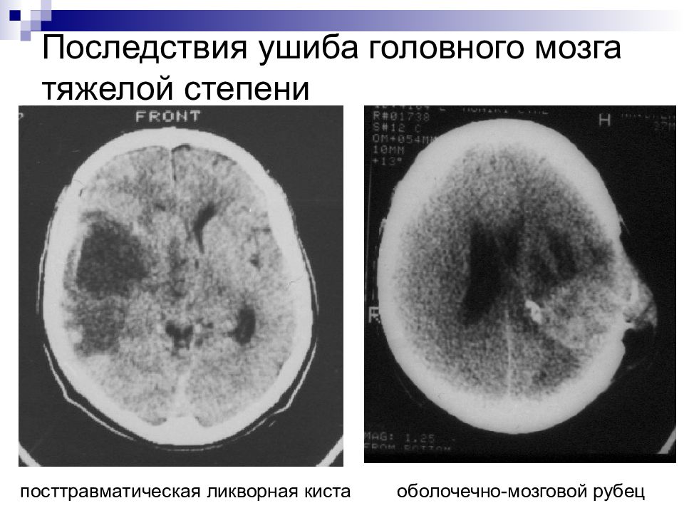Удар мозга последствия. Ушиб головного мозга тяжелой степени. Ушиб ГМ тяжелой степени. Ушиб головного мозга легкой степени. Ушиб головного мозга средней степени.