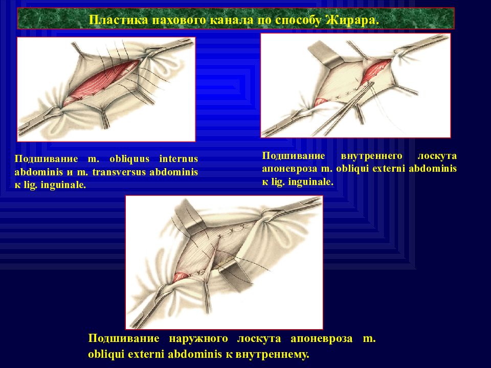 Канал пластика. Пластика грыжи по Жирару Спасокукоцкому. Паховая грыжа метод Жирара. Пластика по Жирару паховая грыжа. Паховая грыжа по Жирару-Спасокукоцкому.