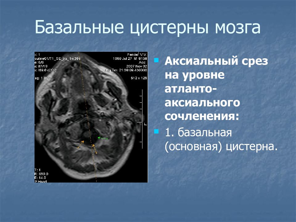 Цистерны мозга расширены. Базальные цистерны головного мозга кт анатомия. Базальные цистерны головного мозга расширены что это. Базальные цистерны головного мозга на мрт. Базальные цистерны головного мозга кт.