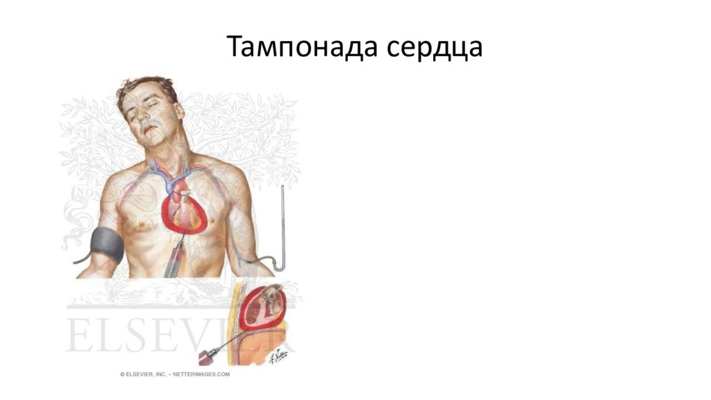 Тампонада сердца что это такое