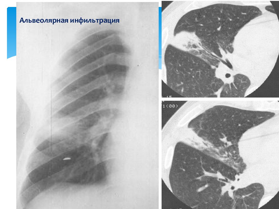 Что такое инфильтрация. Инфильтрация легочной ткани на кт. Пневмония перибронхиальная инфильтрация. Альвеолярная инфильтрация на кт. Альвеолярный Тип инфильтрации при пневмонии.