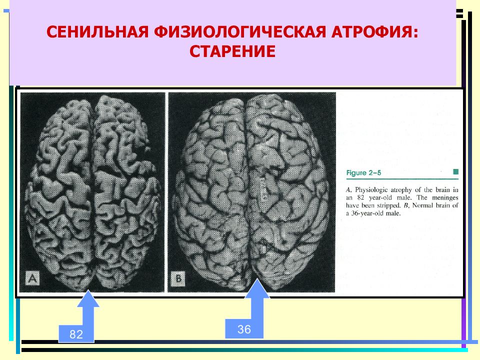 Атрофия мозга симптомы. Физиологическая атрофия. Физиологическая атрофия внешние признаки. Сенильная деменция головного мозга. Физиологическая атрофия примеры.