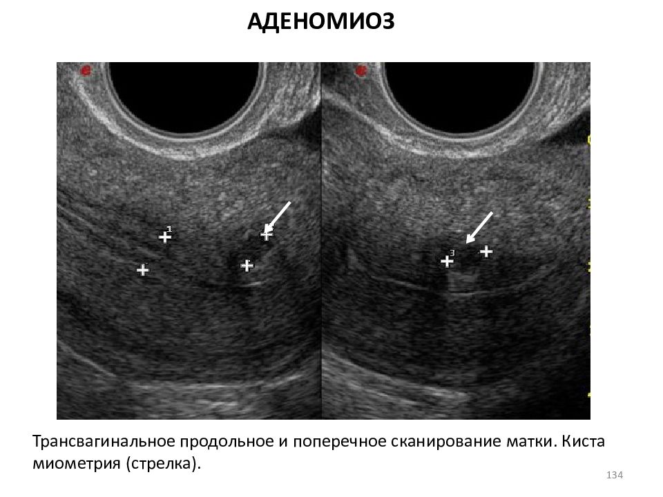 Диффузные изменения миометрия аденомиоз. Узловая форма аденомиоза матки на УЗИ. Киста эндометрия матки. Узловой аденомиоз матки.
