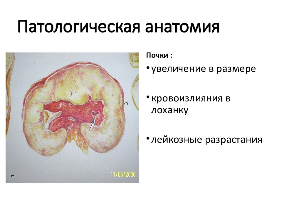 Чума патологическая анатомия презентация