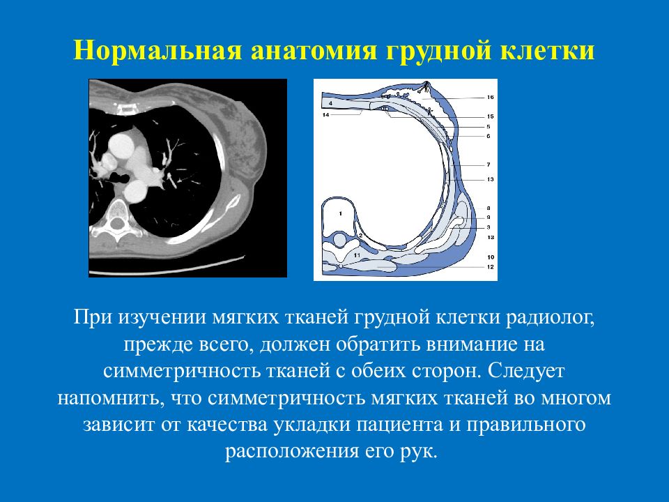 Кт клетки. Анатомия мягких тканей грудной клетки. Мягкие ткани грудной клетки кт анатомия. Кт грудной клетки для презентации. Кт анатомия грудной клетки.