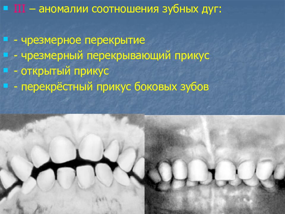 Внутренняя окклюзия. Аномалии соотношения зубных дуг. Перекрестный прикус боковых зубов. Дистальный перекрестный прикус. Буккальный перекрестный прикус.