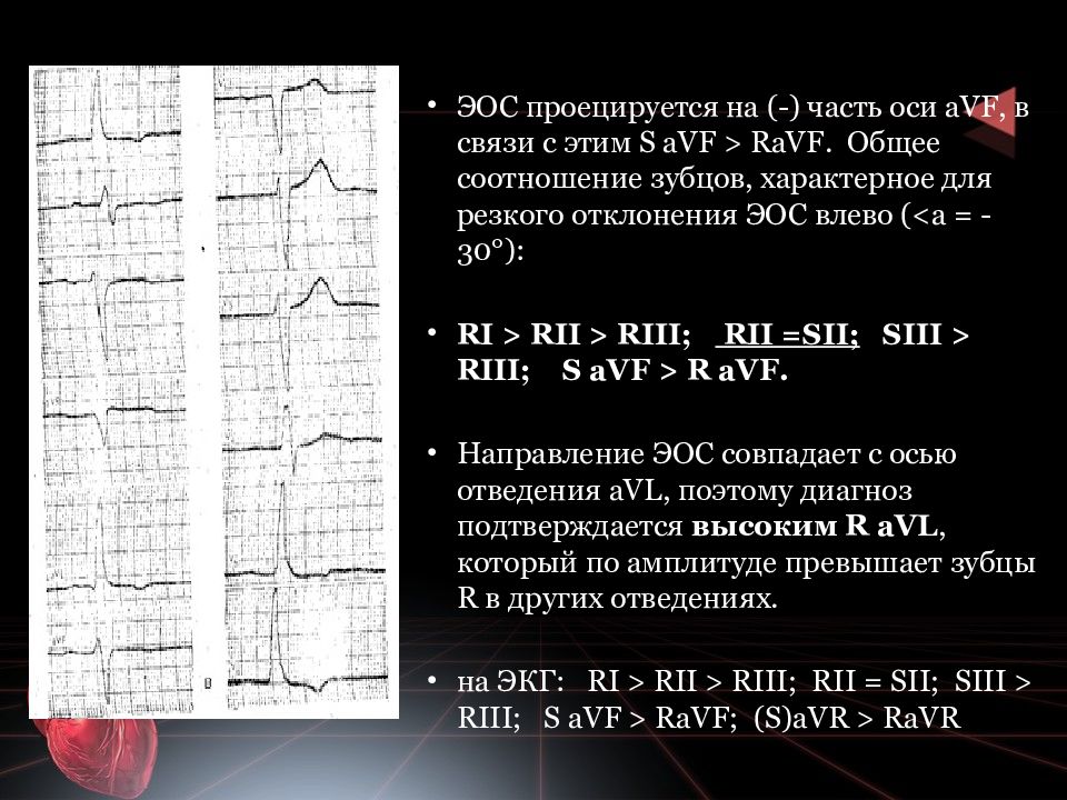 Горизонтальная эос. Электрическая ось сердца s1s2s3. Электрическая ось сердца s1-s2-s3 на ЭКГ. ЭКГ ось типа s1 s2 s3. ЭОС В норме на ЭКГ.