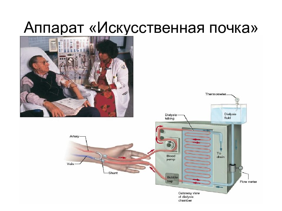 Презентация искусственная почка