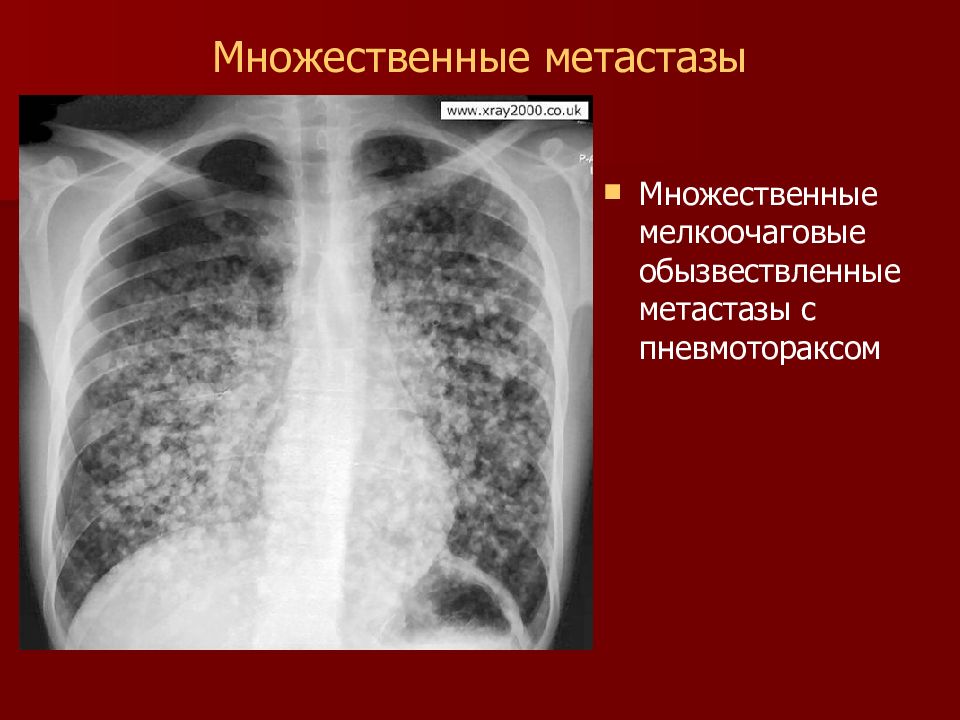 Метастазы в легких. Мелкоочаговая пневмония рентген. Множественные метастазы. Рентгенодиагностика опухолей легких. Двусторонняя мелкоочаговая пневмония.