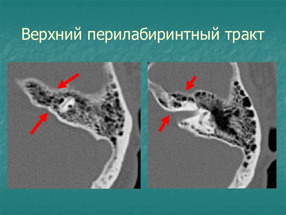 Кт анатомия сосцевидного отростка. Анатомия сосцевидного отростка височной кости на кт. Ячейки височной кости кт. Сосцевидный отросток височной кости кт.