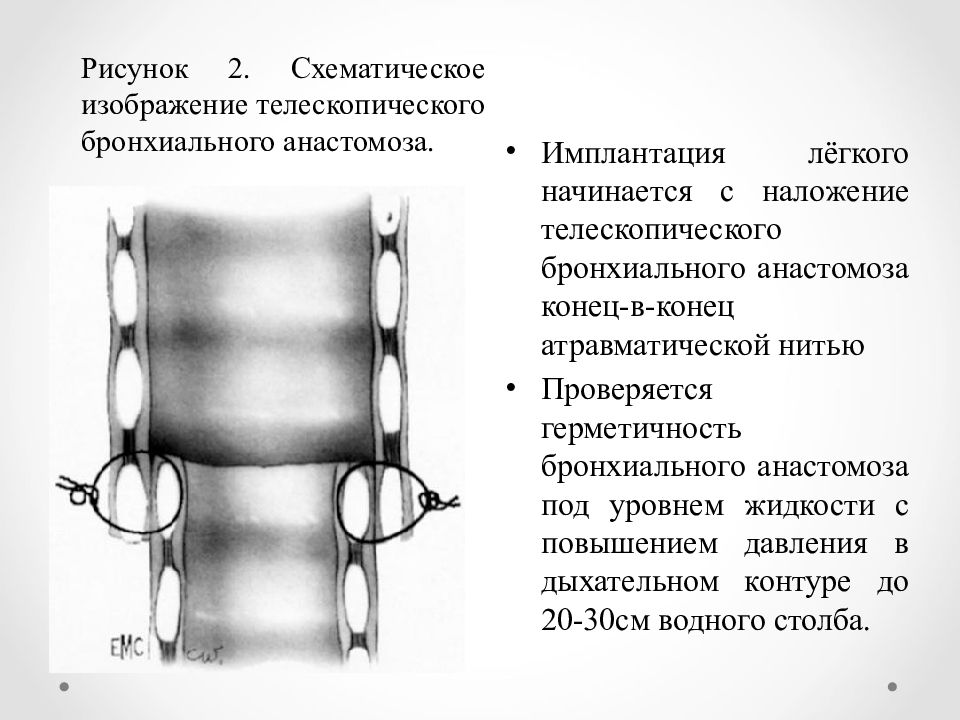 Трансплантация легких презентация