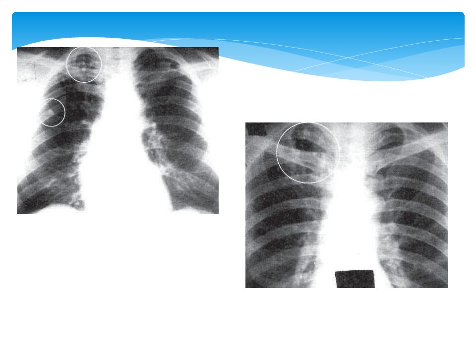 Туберкулез легкого рентгенограмма. Очаговый туберкулез легкого рентген. Очаговый туберкулёз лёгких рентген. Мягкоочаговый туберкулез легких рентген. Очаговый туберкулез легких рентген.