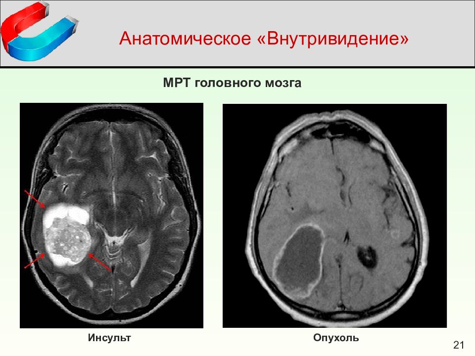 Инсульт на мрт головного мозга картинки