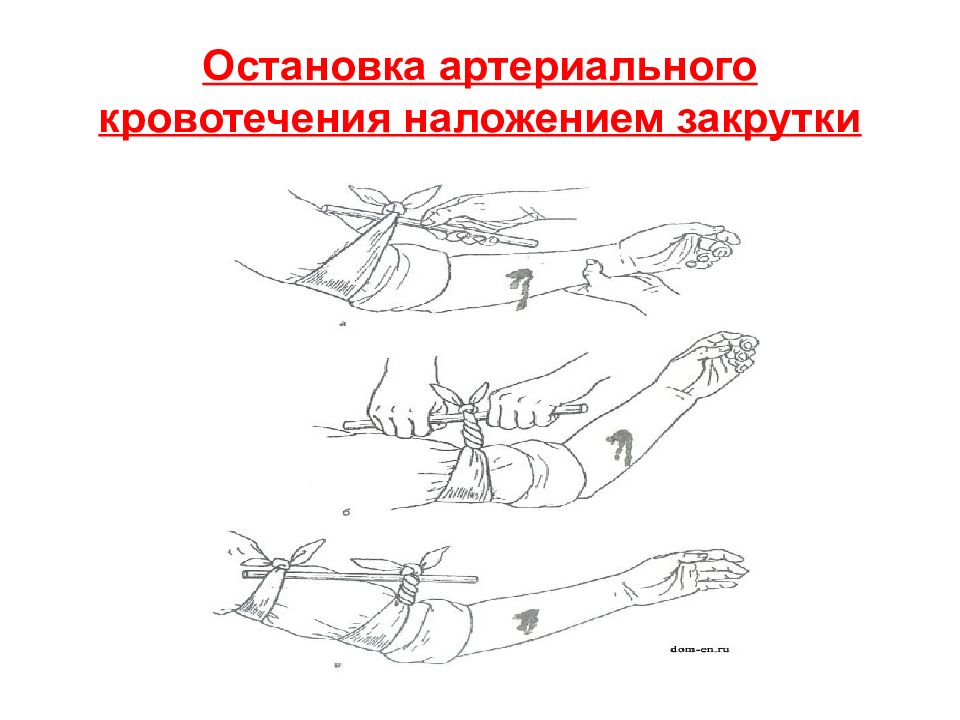 Приемы остановки артериального кровотечения