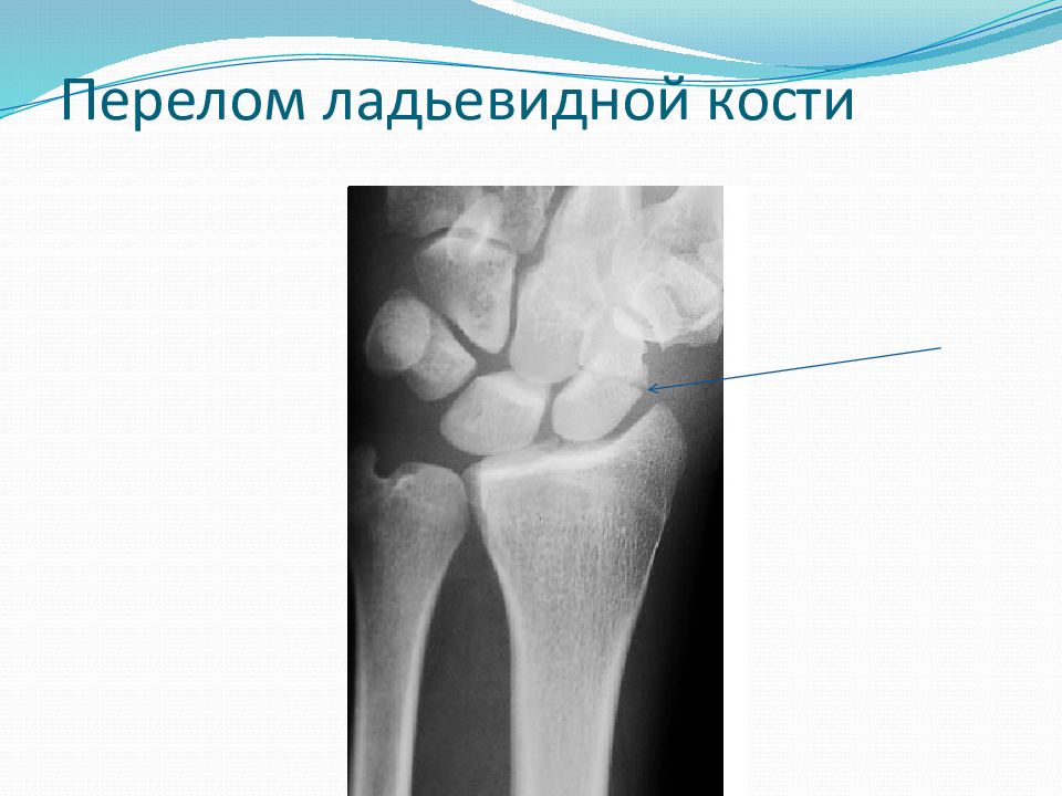 Шиловидная кость перелом