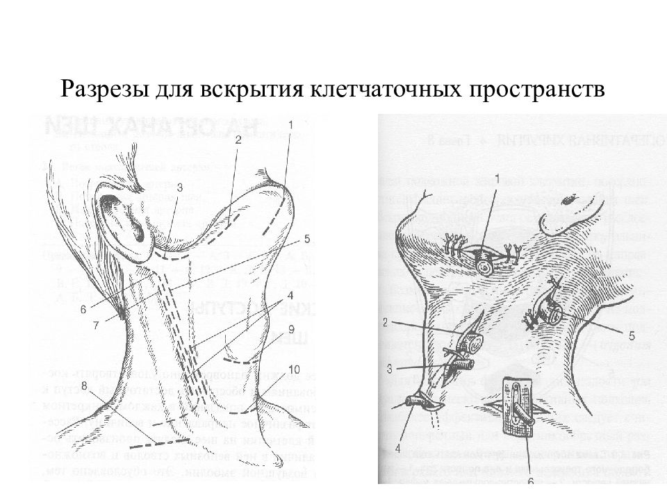 Топографическая хирургия. Разрезы шеи Оперативная хирургия. Флегмоны шеи топографическая анатомия. Разрезы на шеи топографическая анатомия. Разрезы при флегмонах шеи.