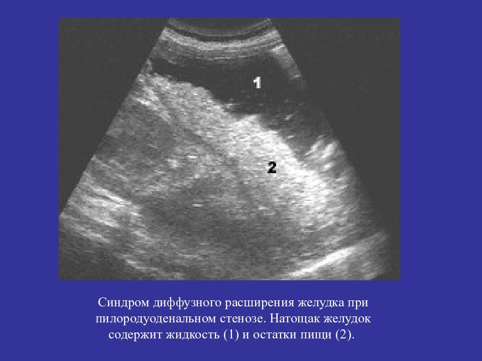 Узи желудка. Диффузное расширение желудка. Стеноз привратника на УЗИ. УЗИ привратника желудка. Расширенный желудок на УЗИ.