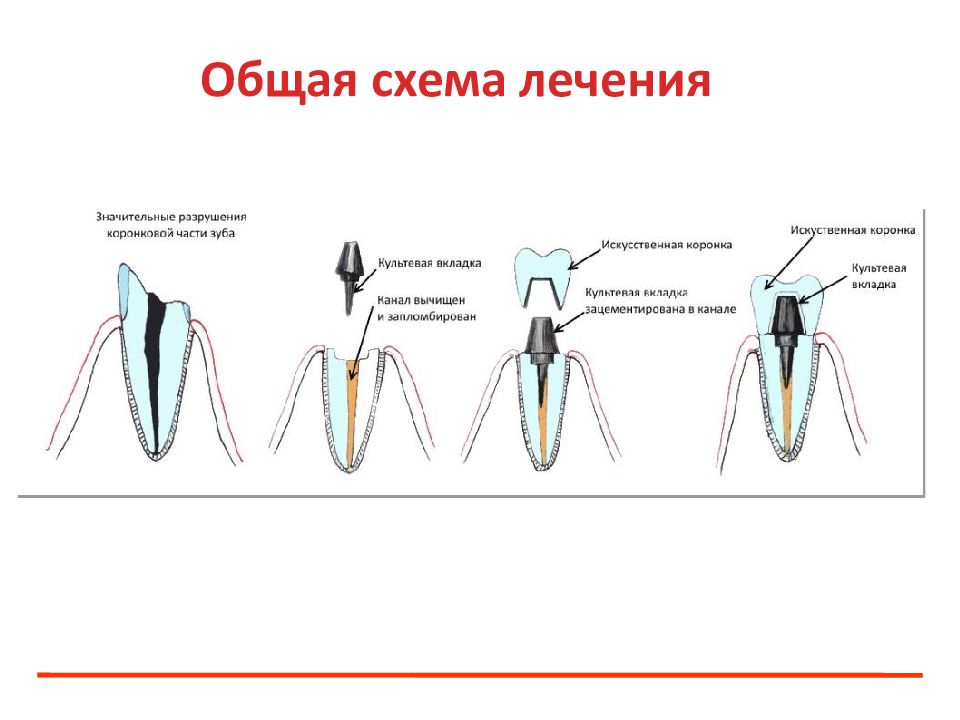 Культевая вкладка зуба