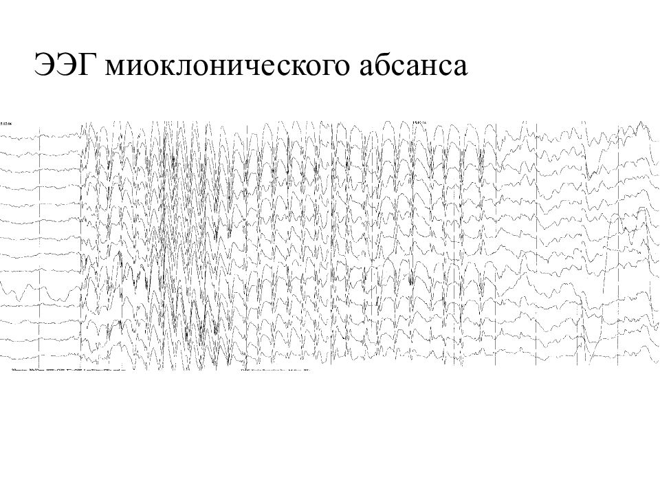 Ээг показывает эпилепсию. Абсанс эпилепсия ЭЭГ. ЭЭГ эпилепсия миоклонические припадки. Миоклоническая эпилепсия ЭЭГ. Паттерн абсанса на ЭЭГ.