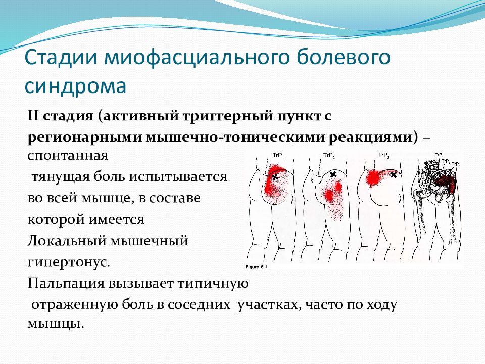 Миофасциальный болевой синдром презентация