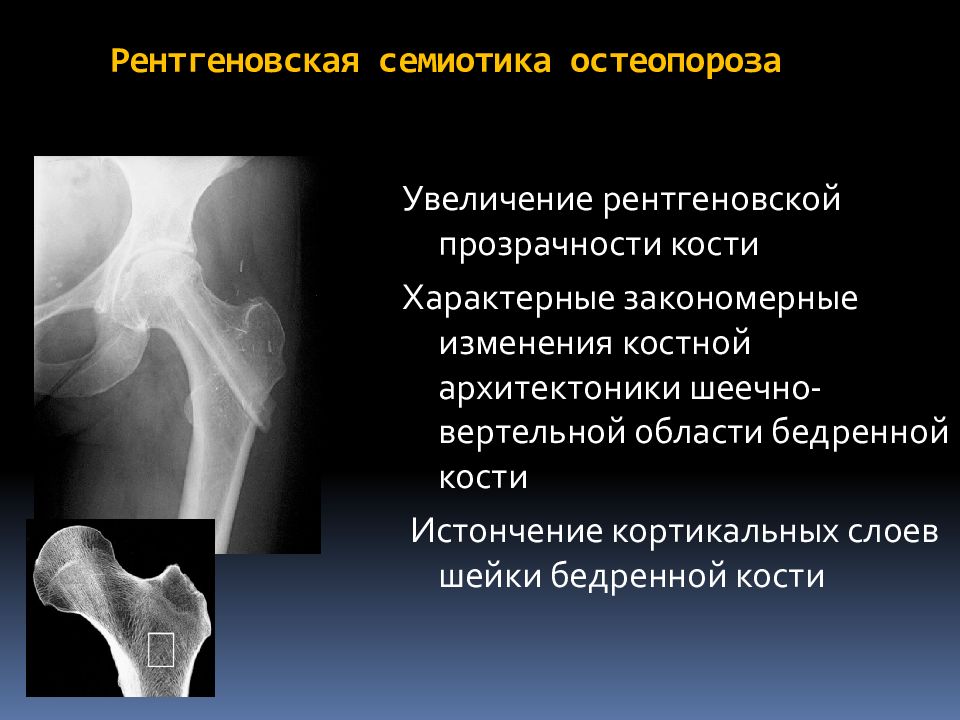 Анализ кости на остеопороз