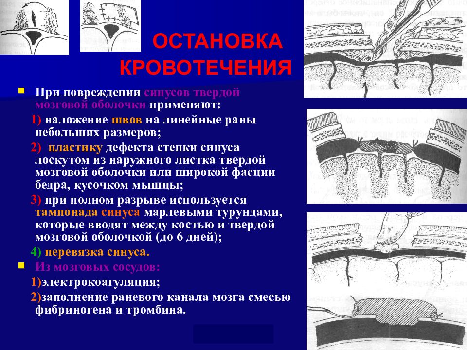 Топографическая анатомия мозгового отдела головы презентация. Операции на твердой мозговой оболочки топографическая анатомия. Долото топографическая анатомия.