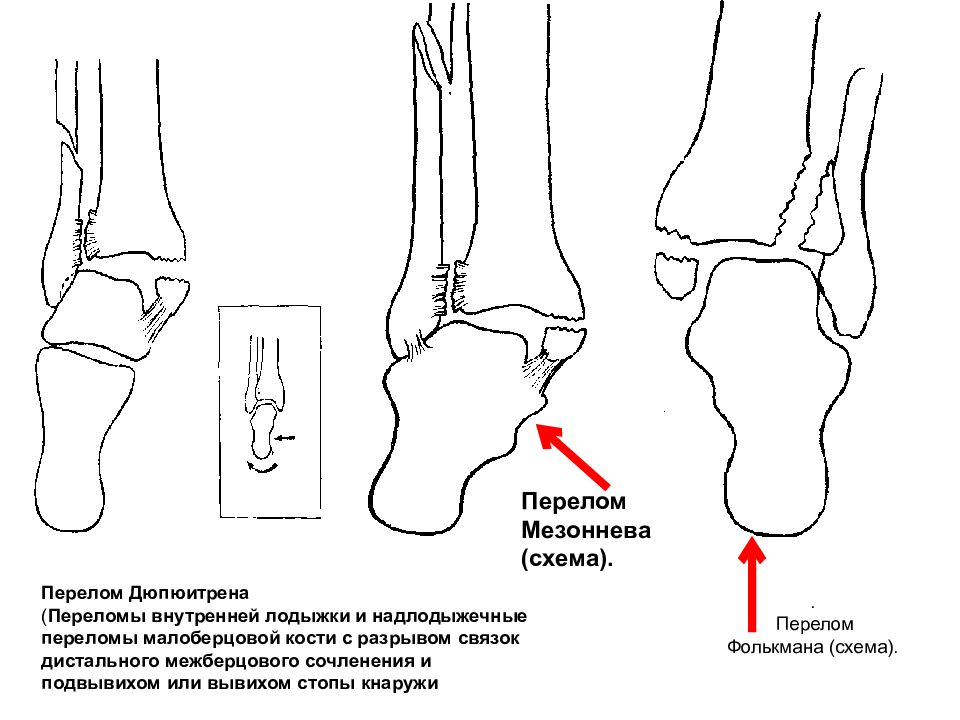 Переломы лодыжек травматология презентация