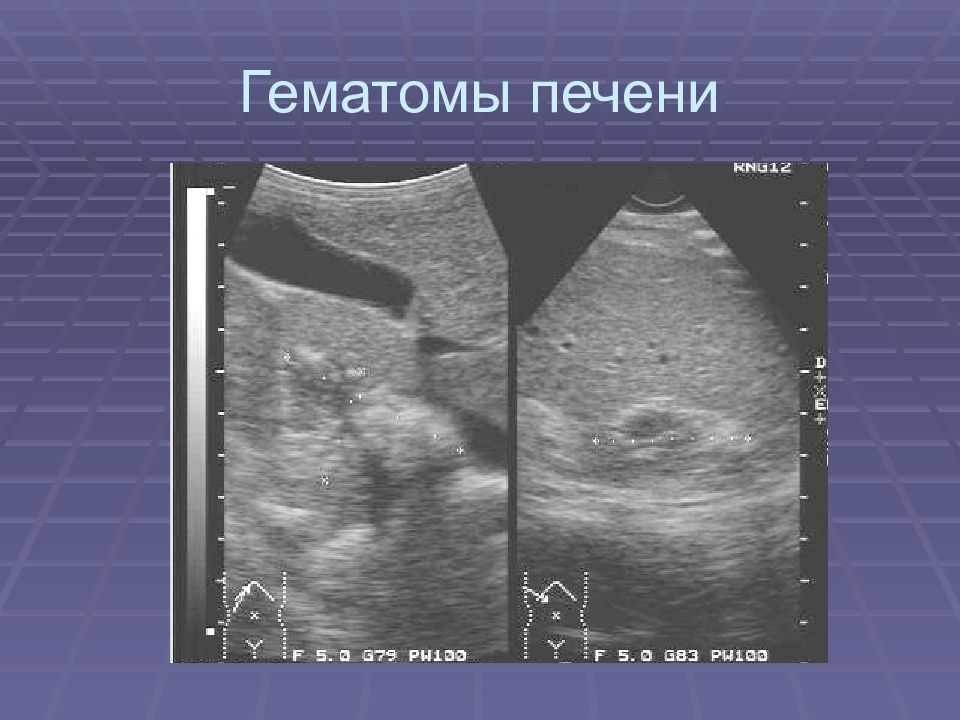 Гематома печени. Подкапсульная гематома печени на УЗИ. Субкапсулярная гематома селезенки УЗИ. Подкапсульная гематома селезенки на УЗИ. Субкапсулярная гематома печени УЗИ.