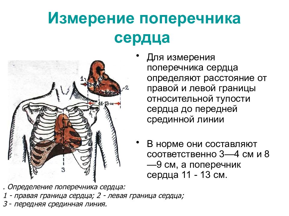 Перкуссия сердца в картинках