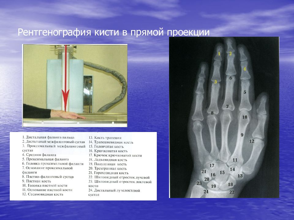 Анатомия рентген. Рентгеноанатомия лучезапястного сустава. Кисть рентген анатомия норма. Суставы кисти рентген анатомия. Лучезапястный сустав рентген анатомия.