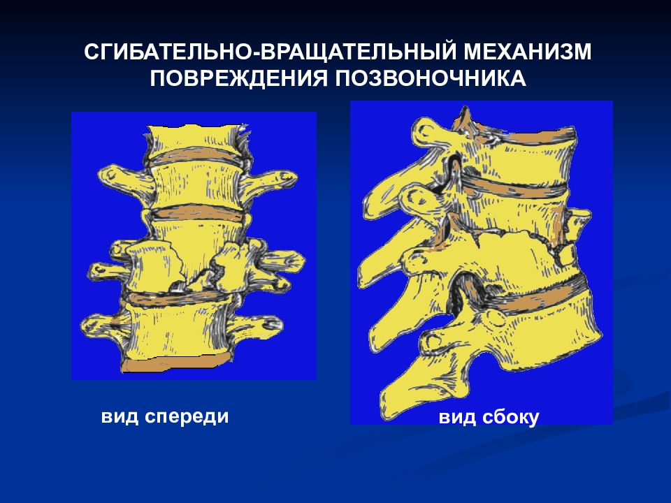 Механизм повреждения. Сгибательно-вращательный механизм повреждения позвоночника. Сгибательный механизм травмы позвоночника. Разгибательный механизм повреждения позвоночника. Перелом позвоночника механизм повреждения.