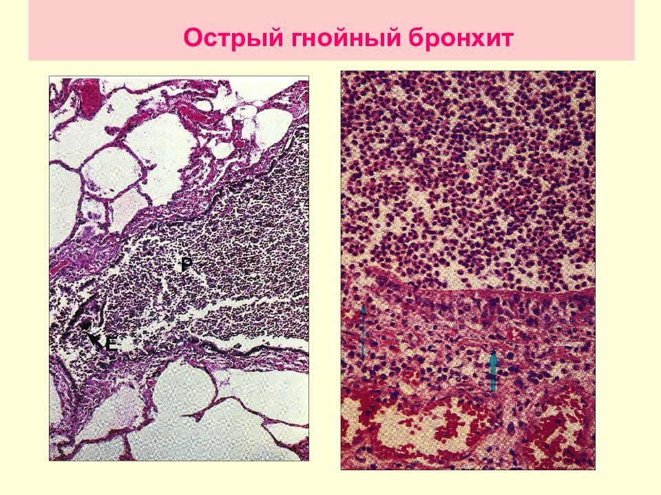 Гнойный бронхит. Хронический бронхит патанатомия. Хронический бронхит микропрепарат. Острый бронхит микропрепарат. Бронхит патанатомия микропрепарат.