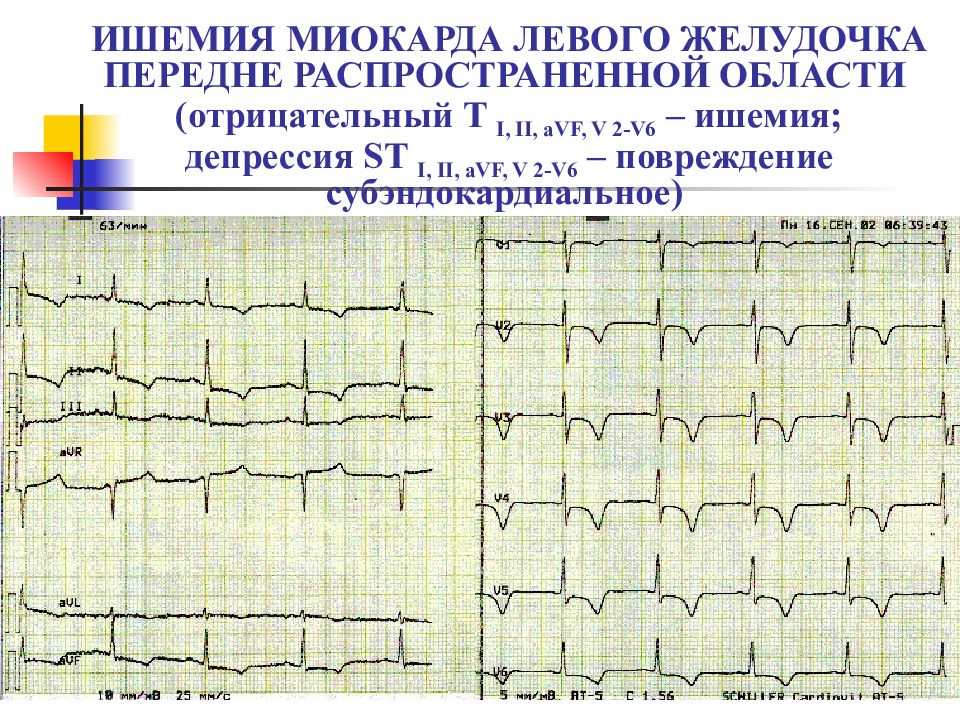 Миокард нижней стенки. Признаки ишемии миокарда на ЭКГ. Ишемия миокарда на ЭКГ. Ишемия миокарда депрессия St. Субэндокардиальный инфаркт миокарда на ЭКГ.