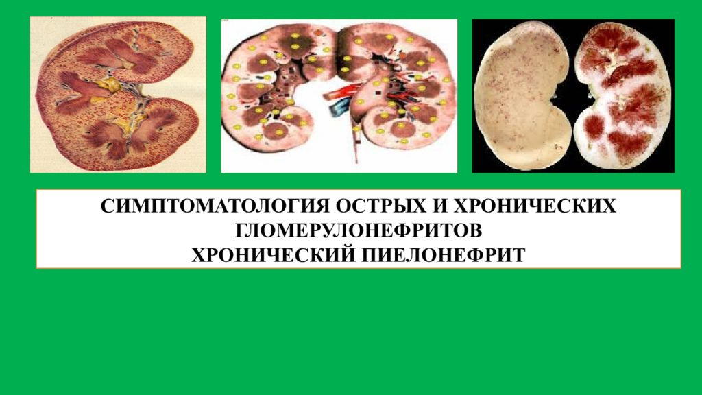 СИМПТОМАТОЛОГИЯ ОСТРЫХ И ХРОНИЧЕСКИХ ГЛОМЕРУЛОНЕФРИТОВ ХРОНИЧЕСКИЙ ПИЕЛОНЕФРИТ