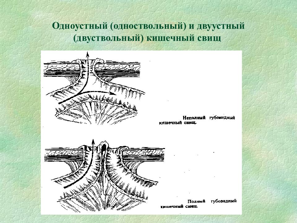 Кишечный свищ. Губовидный кишечный свищ. Несформированный кишечный свищ. Кишечные свищи губовидные и трубчатые. Неполный кишечный свищ.