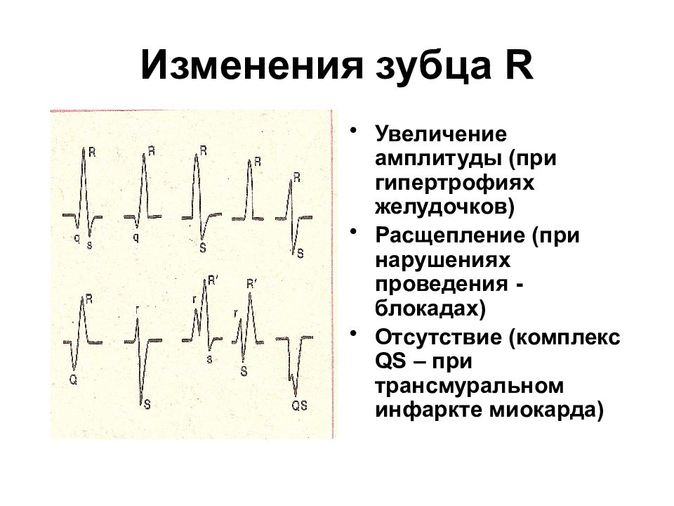 Увеличение амплитуды. ЭКГ В v1 расщепление зубца q. ЭКГ расщепление зубца r в v1 и v2. Расщепленный зубец r на ЭКГ В v1. Расщепленный зубец r на ЭКГ В 3 отведении.