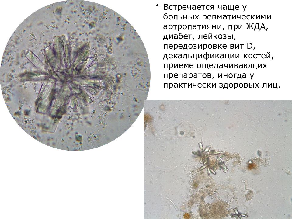 Ураты в моче диета. Фосфорнокислый кальций в моче. Микроскопия осадка мочи. Осадки мочи микроскопия презентация. Фосфорнокислый кальций в моче микроскопия.