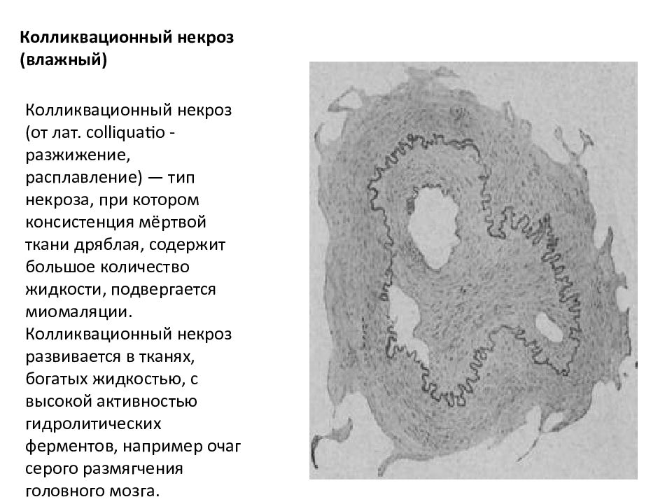 Мертвая ткань. Колликвационный некроз макропрепарат. Колликвационный некроз микропрепарат. Колликвационный некроз гистология. Колликвационный гангрена.