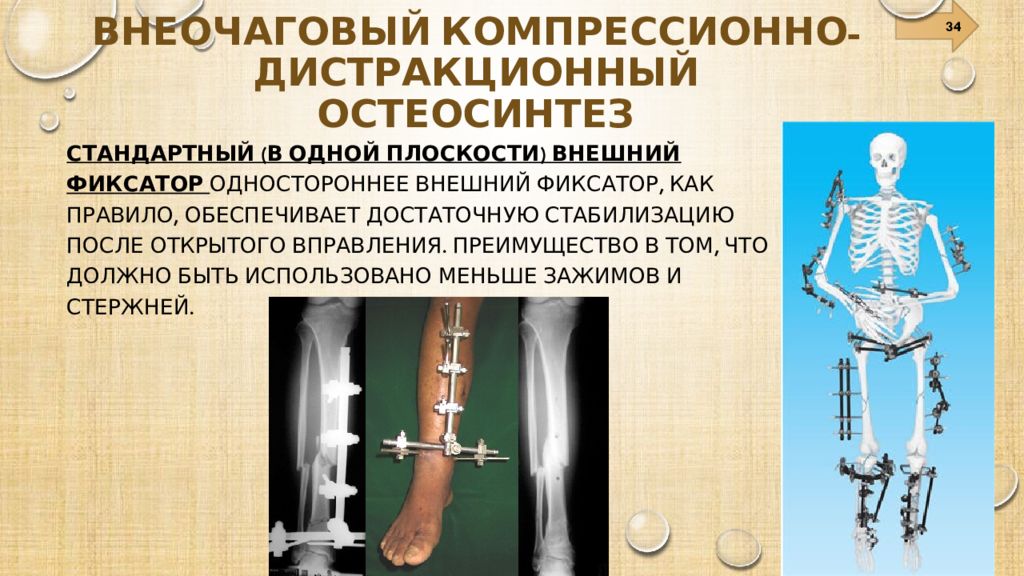 Внешняя фиксация при переломах. Аппарат чрескостного остеосинтеза. Аппараты внешней фиксации классификация. Погружной чрескостный остеосинтез. Компрессионно-дистракционный остеосинтез аппараты.