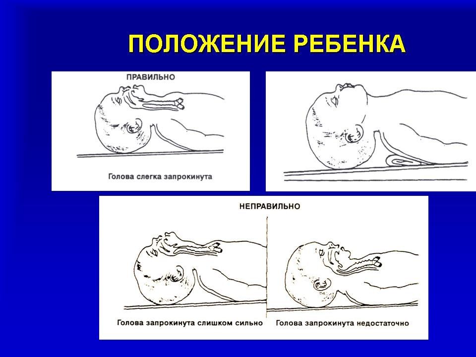 Слр новорожденных презентация