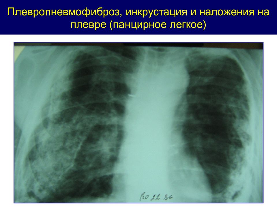 Локальный пневмофиброз легких. Обызвествление плевры. Апикальный плевропневмофиброз. Плевропневмофиброз лёгких рентген.