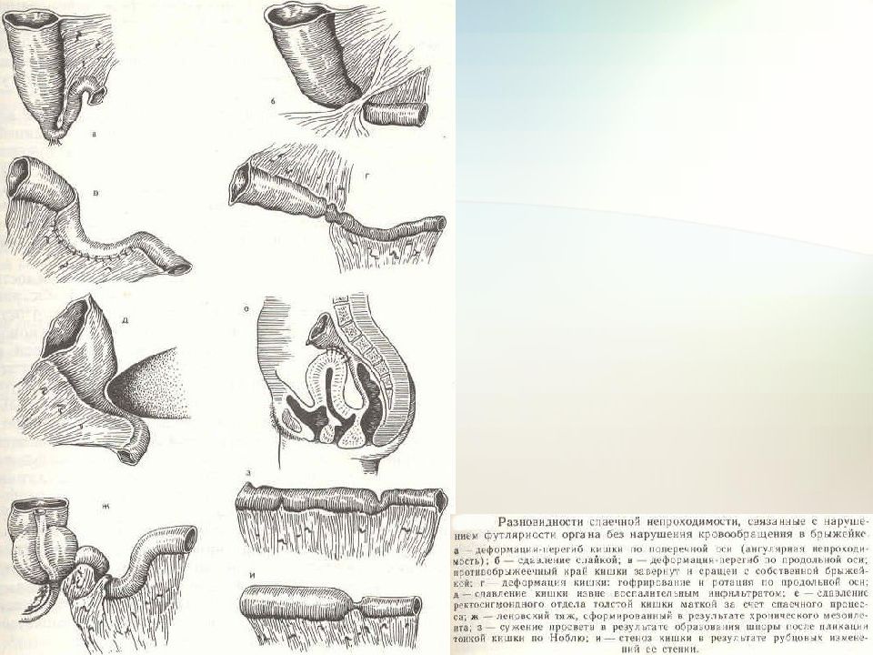 Спайки живота у женщин. Спаечная болезнь брюшины хирургия. Классификация спайки кишечника. Спаечная кишечная непроходимость.