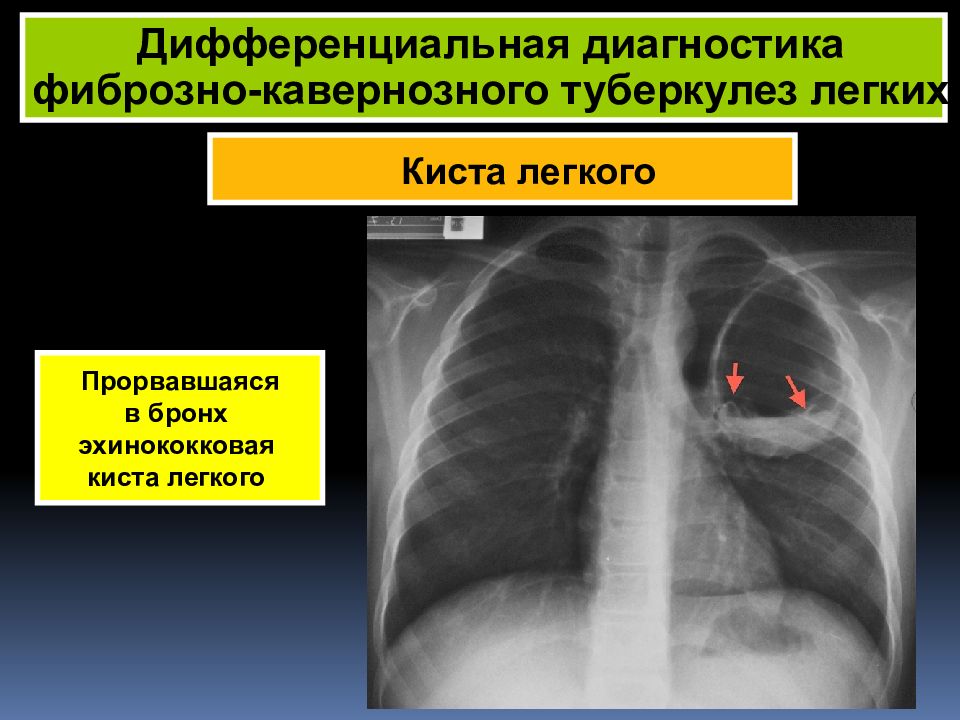 Рентген картина при фиброзно кавернозном туберкулезе легких характеризуется