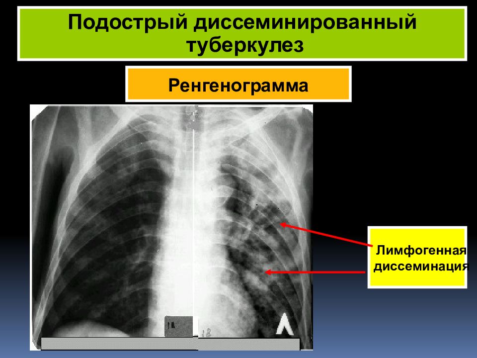 Лимфогенный туберкулез. Диссеминация туберкулеза на рентгене. Острый диссеминированный туберкулез рентген. Лимфогенно диссеминированный туберкулез рентген. Подострый диссеминированный туберкулез кт.