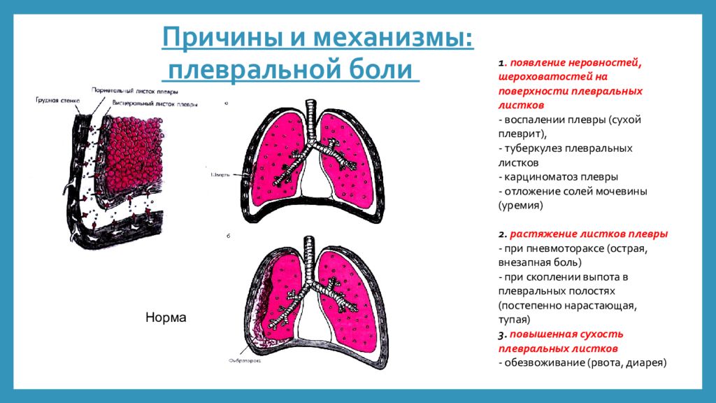 Боли при сухом плеврите. Патогенез сухого плеврита. Механизм развития экссудативного плеврита. Патогенез сухого плеврита схема. Сухой плеврит этиология.