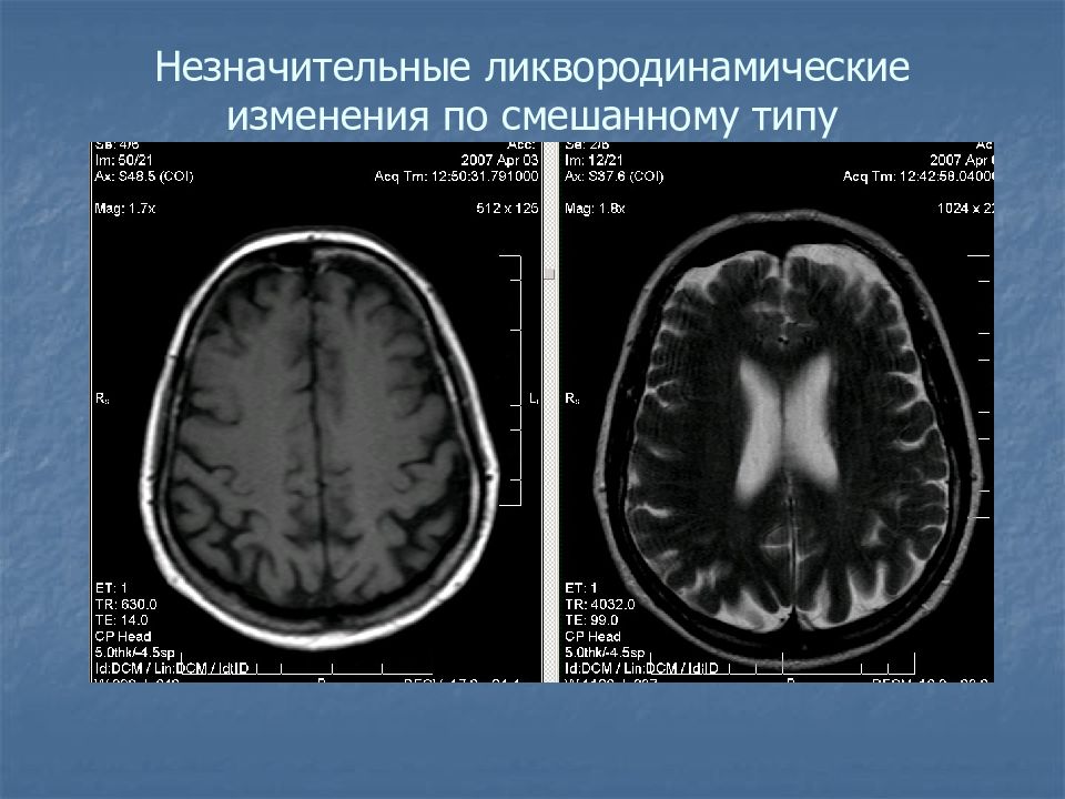 Гидроцефалия головного мозга картинки