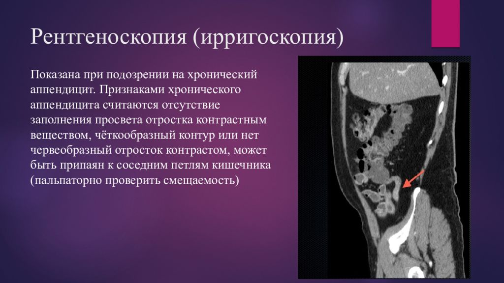 Хронический аппендицит презентация